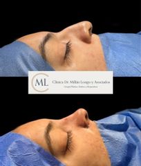 Rinoplastia ultrasónica