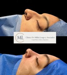 Rinoplastia ultrasónica