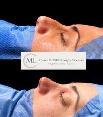 Rinoplastia ultrasónica