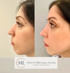 Rinoplastia ultrasónica
