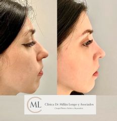Rinoplastia ultrasónica