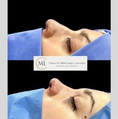 Rinoplastia ultrasónica