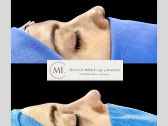 Rinoplastia antes y después - 878377