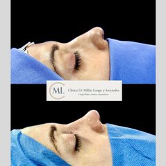 Rinoplastia ultrasónica