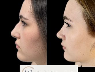 Rinoplastia antes y después - 878378