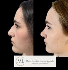 Rinoplastia ultrasónica