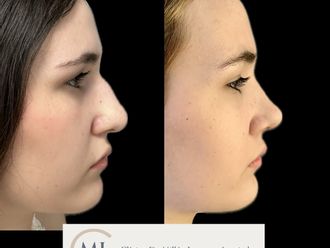 Rinoplastia antes y después - 878379