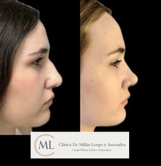 Rinoplastia ultrasónica