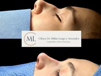 Rinoplastia antes y después - 878380