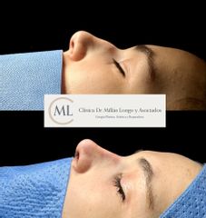 Rinoplastia ultrasónica