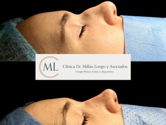 Rinoplastia antes y después - 878460