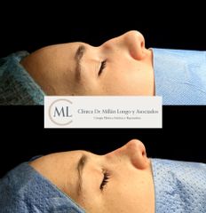 Rinoplastia ultrasónica