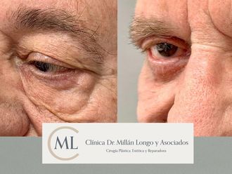Blefaroplastia antes y después - 878461