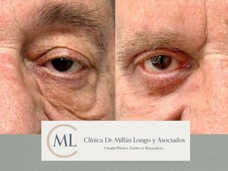 Blefaroplastia antes y después - 878462