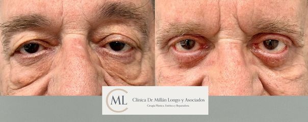 Blefaroplastia completa
