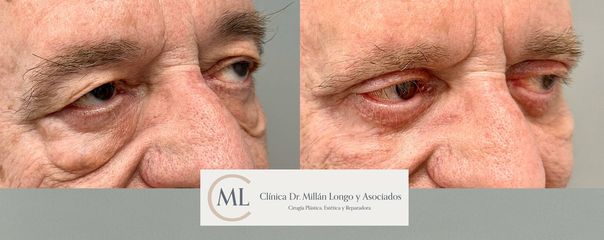 Blefaroplastia completa