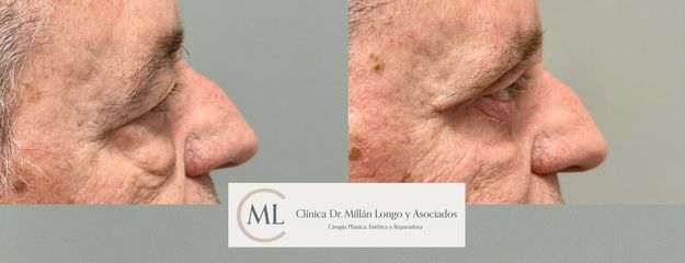 Blefaroplastia completa