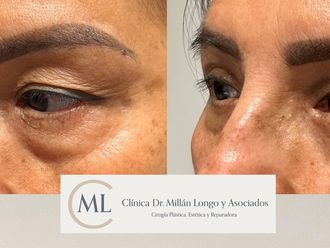Blefaroplastia antes y después - 878465