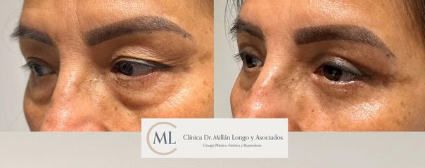 Blefaroplastia completa