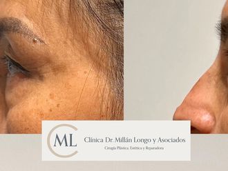 Blefaroplastia antes y después - 878466