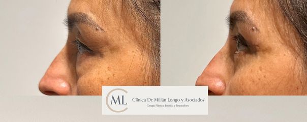 Blefaroplastia completa