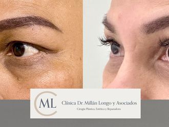 Blefaroplastia antes y después - 878467