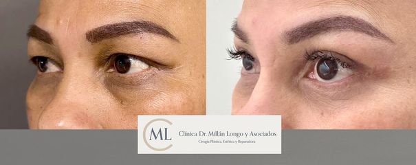 Blefaroplastia completa