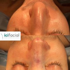 Rinoplastia - ICIfacial
