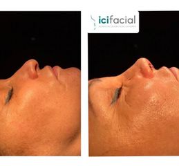 Rinoplastia - ICIfacial