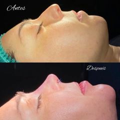 Rinoplastia - ICIfacial