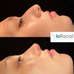 Rinoplastia - ICIfacial