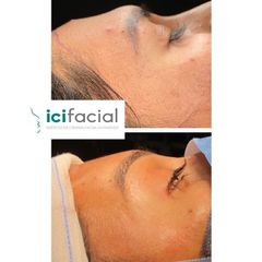 Lifting - ICIfacial