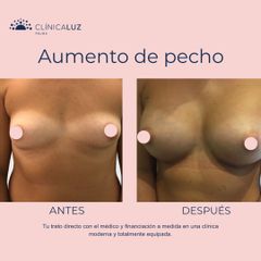 Aumento de pecho - Clínica Luz
