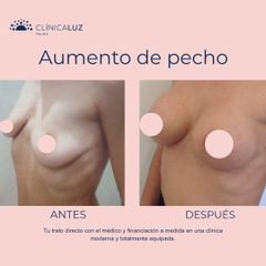 Aumento de pecho - Clínica Luz