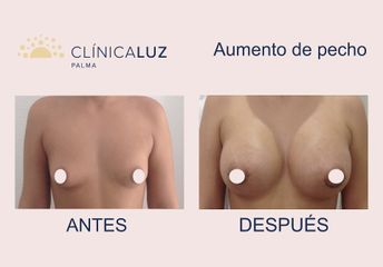 Aumento de pecho - Clínica Luz