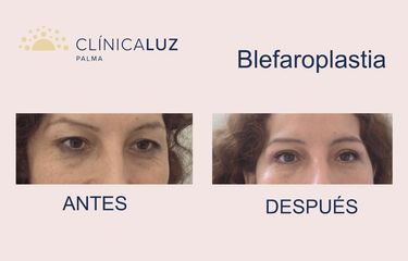 Blefaroplastia - Clínica Luz