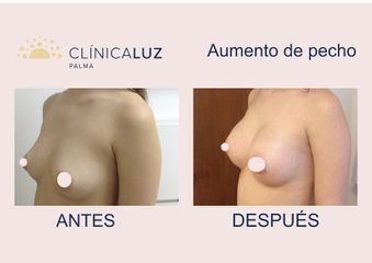 Aumento de pecho - Clínica Luz