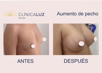 Aumento de pecho - Clínica Luz