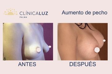 Aumento de pecho - Clínica Luz