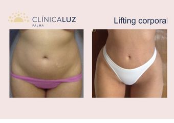Lifting corporal - Clínica Luz