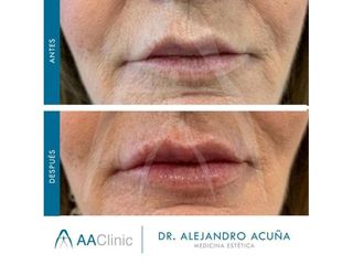 Aumento de labios - AA CLINIC