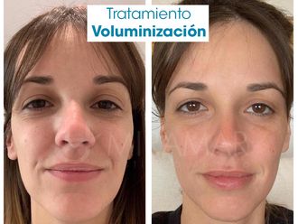 Rellenos faciales - 636039