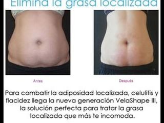 Remodelacion corporal - Clínica Openderma