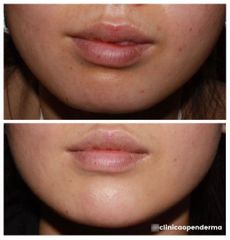Aumento de labios - Clínica Openderma