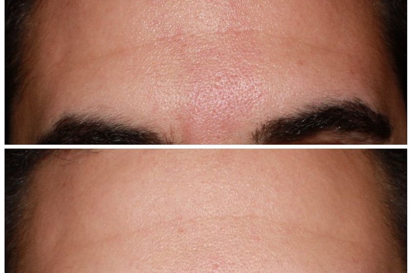Angiomas antes y después - 790016