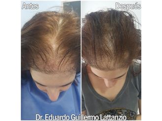 Tratamiento capilar - 649301