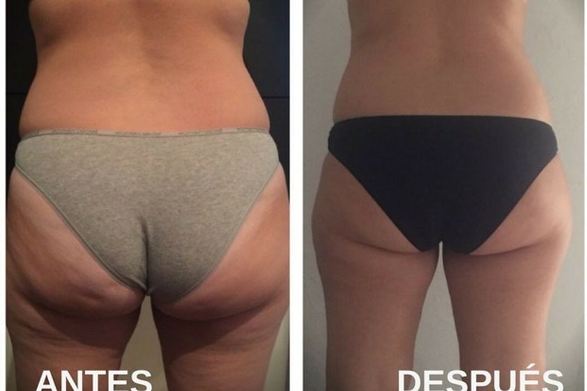 Mesoterapia antes y después - 604692