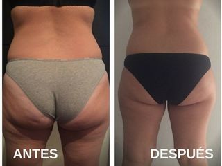 Antes y después mesoterapia 