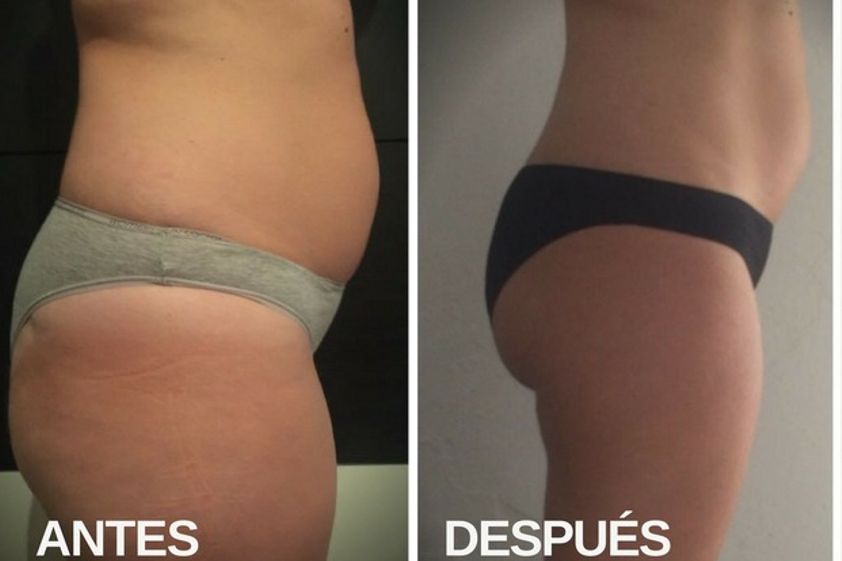 Mesoterapia antes y después - 604693