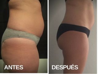 Antes y después mesoterapia 